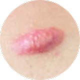 Surgical Scars