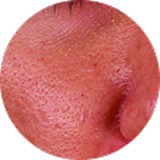 Enlarged Pores