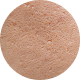 Acne Scars