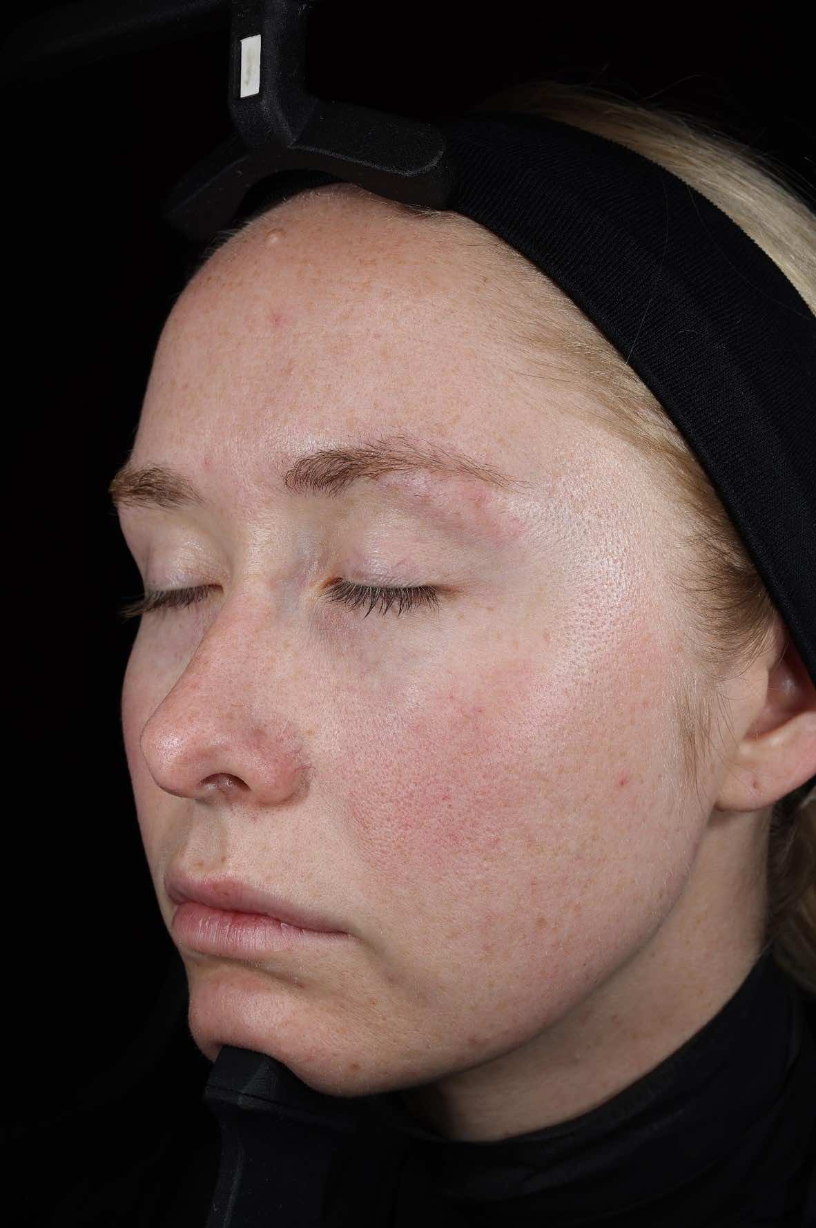 SkinPen treatment progress Before